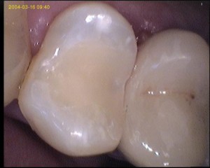 Implantes dentales