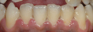 gingivitis y periodontitis en implantes dentales