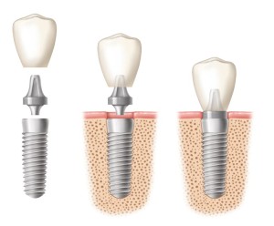 implantes dentales