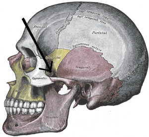 pacientes con poco hueso implantes dentales