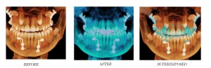 Implantes dentales