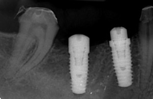 implantes dentales postextracción