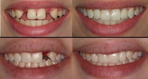 Ventajas de implantes dentales cigomáticos