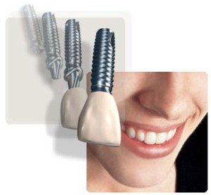 Diferentes técnicas de colocación de implantes dentales