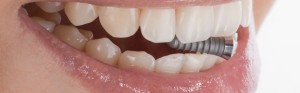 ¿De qué materiales están hechos los implantes dentales?