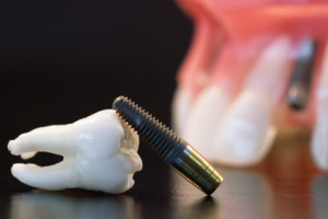 Soluciones de implantes dentales para personas con poco hueso