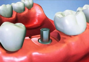 Motivos para colocar implantes dentales en verano
