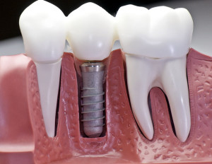 implantes dentales ventajas