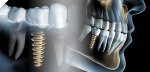 implantes dentales navidad